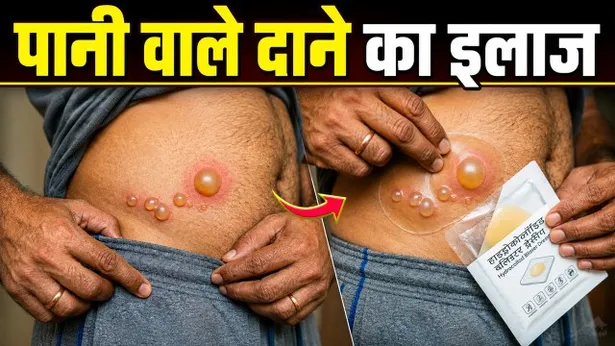Water Blisters Treatment At Home: Pani Wale Dane Ka Gharelu Ilaj,Funsi Kyu Hoti Hai ?